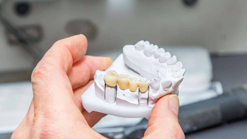 crowns and bridges in brighton