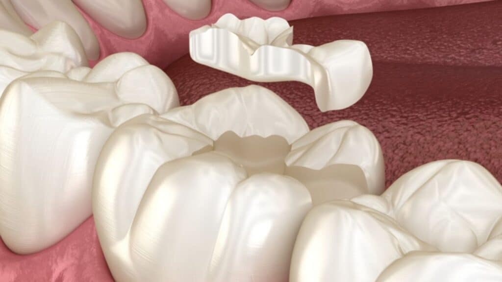 inlays and onlays in brighton